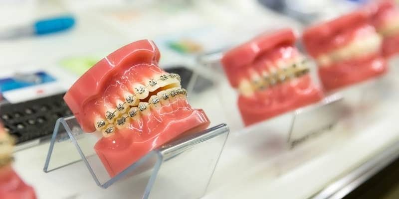 Orthodontic Treatment