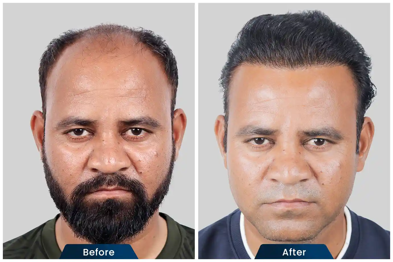 FUE Hair Transplant