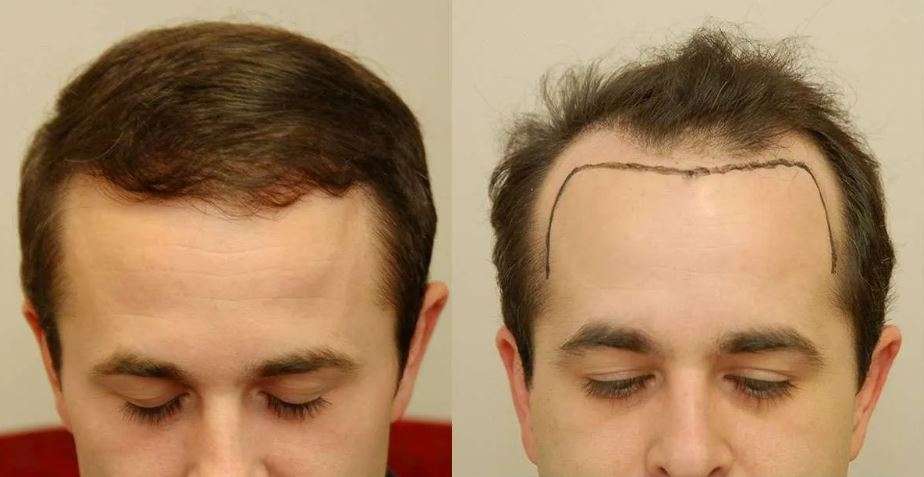 FUT Hair Transplant